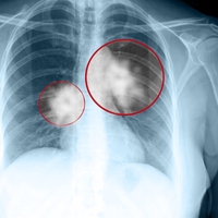emphysema
