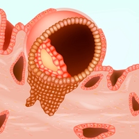 implantation