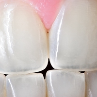 incisors