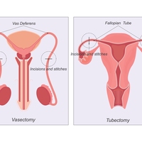 sterilisation