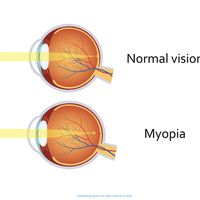 myopia (short-sightedness)