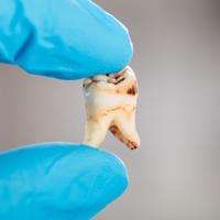 tooth decay