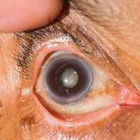 cataract