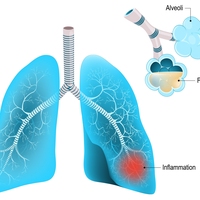 pneumonia