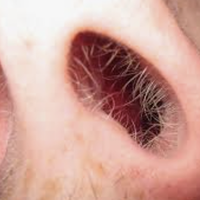 nose hair