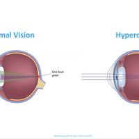hyperopia (long-sightedness)