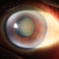 cataract