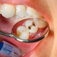 cavity
