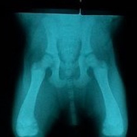 pelvis
