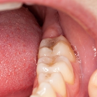 molars
