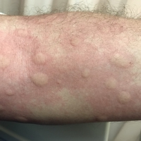 allergy