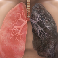 non-communicable disease