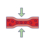 vasoconstriction