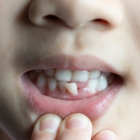 incisors