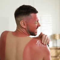 sunburn